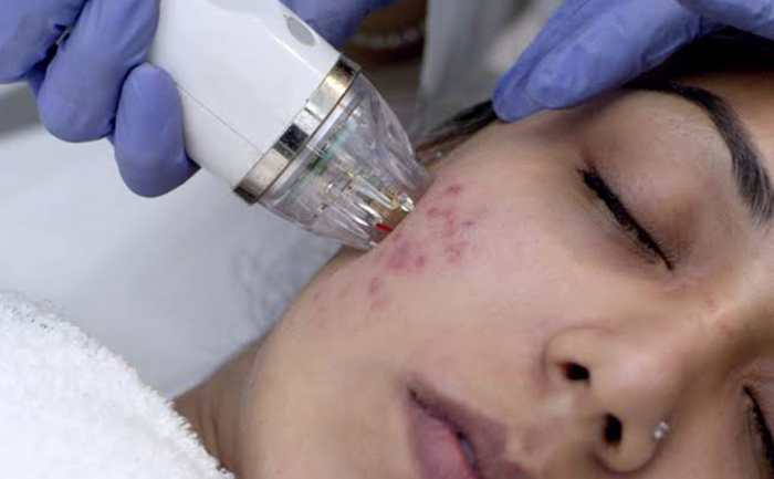 Acne & Acne Scar Treatment