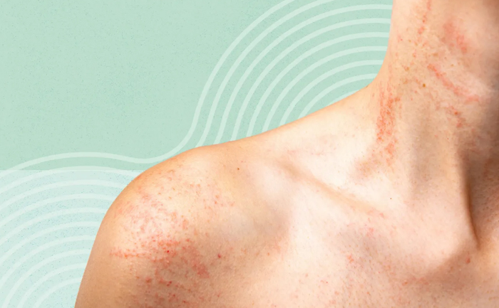 Skin Allergies & Rashes