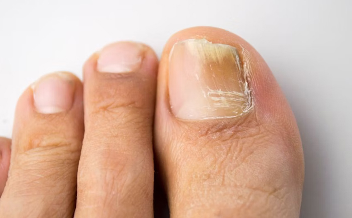Wart & Nail Disorder Treatment